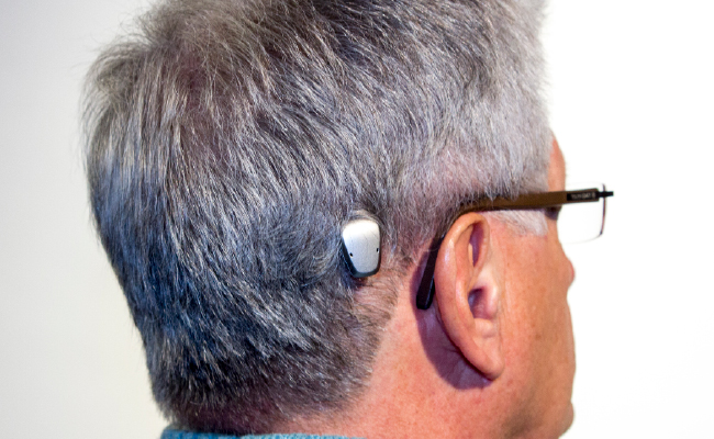 Bone Conduction Implants